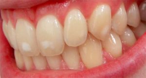 The Worst Dangers of Fluoride And How To Treat It